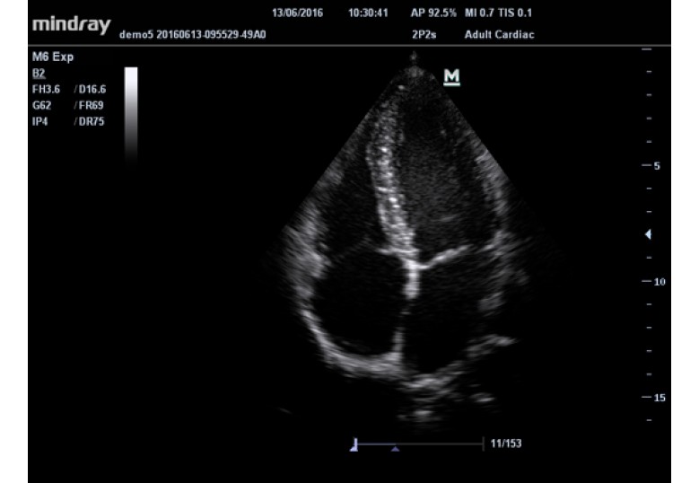 Diagnostic Ultrasound Machines