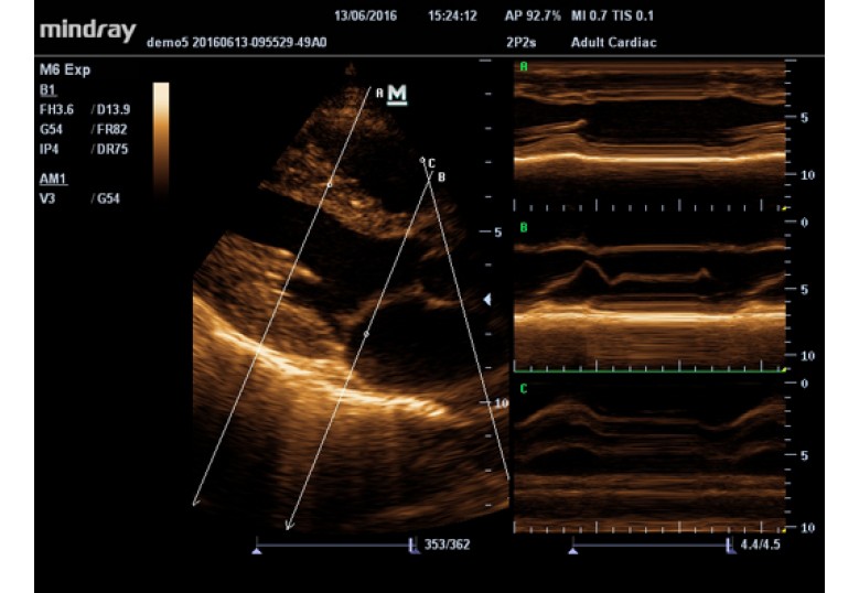 Diagnostic Ultrasound Machines