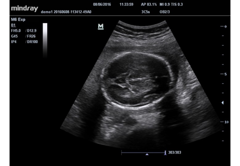 Diagnostic Ultrasound Machines